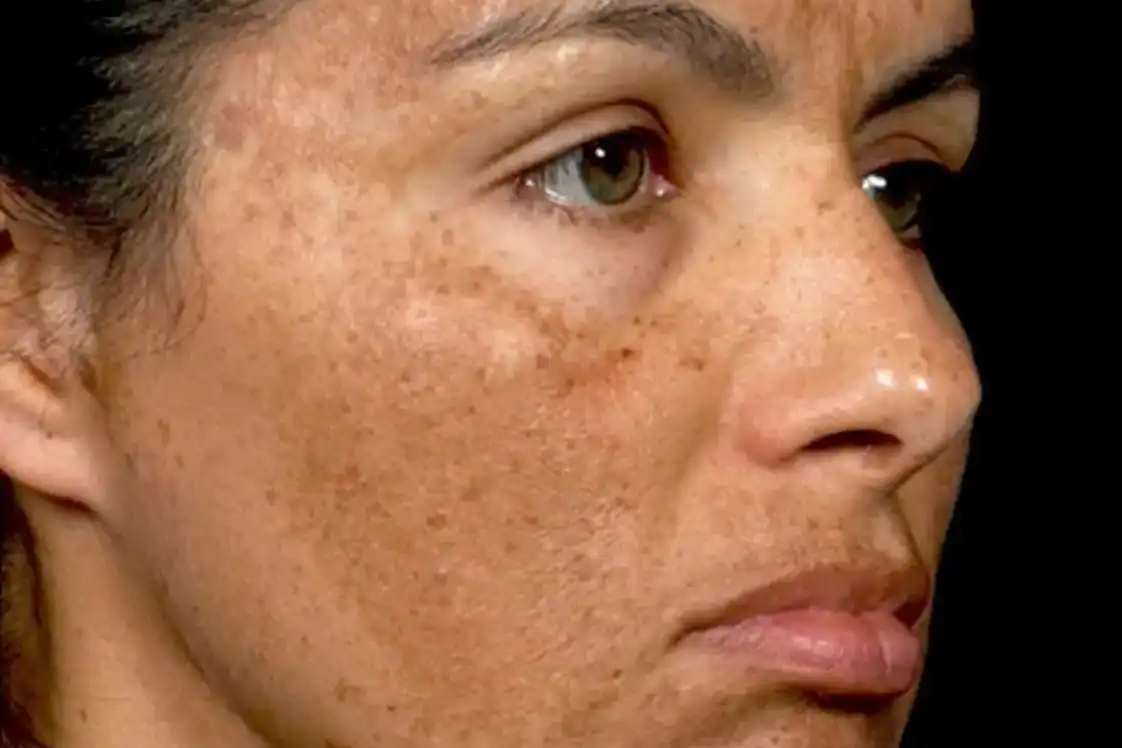Anti Pigmentation